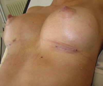 Come fregare gambe con aceto di sidro di mela da varicosity