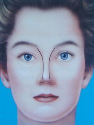 © Dallas Rhinoplasty (QMP) larghezza ideale del naso