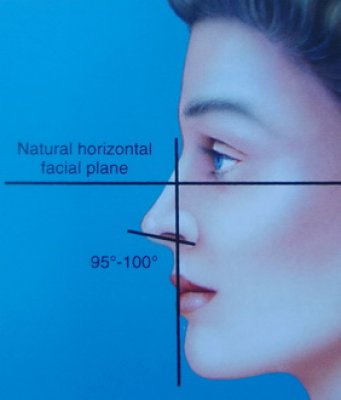 © Dallas Rhinoplasty (QMP) sollevamento ideale della punta del naso