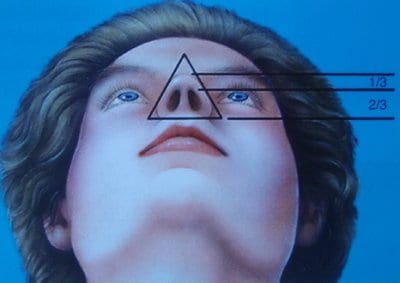 © Dallas Rhinoplasty (QMP) forma ideale della base del naso
