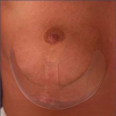 applicazione silicone al seno