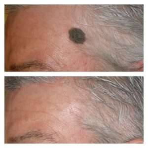 ASPORTAZIONE DI LESIONI CUTANEE BENIGNE 2