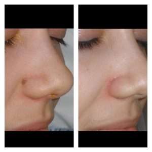 ASPORTAZIONE DI LESIONI CUTANEE BENIGNE 2