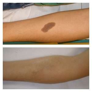 ASPORTAZIONE DI LESIONI CUTANEE BENIGNE 3