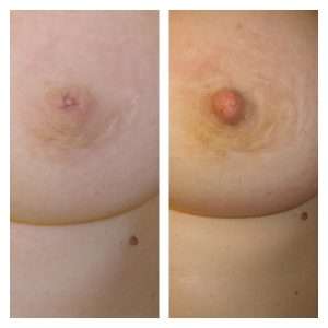 Capezzolo Introflesso