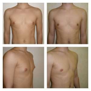 Ginecomastia 4