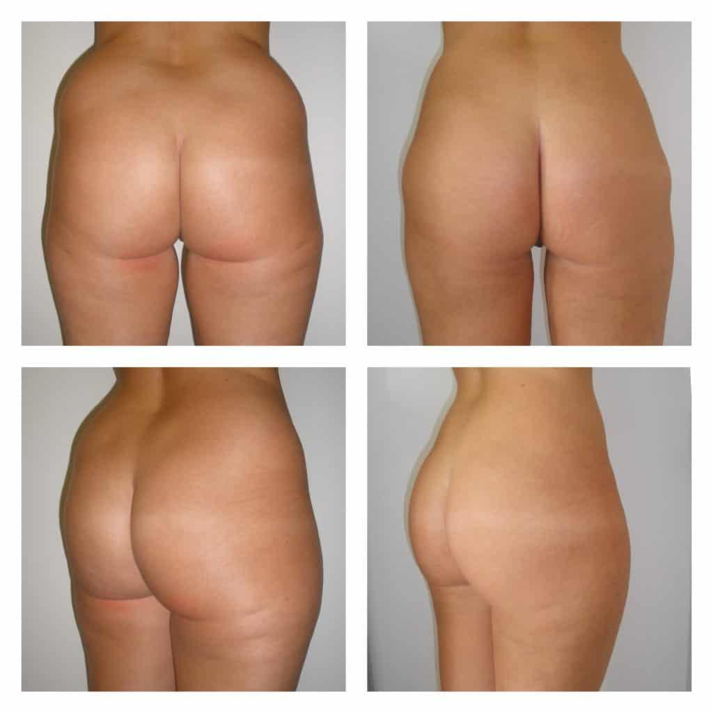 Liposuzione-Liposcultura 6