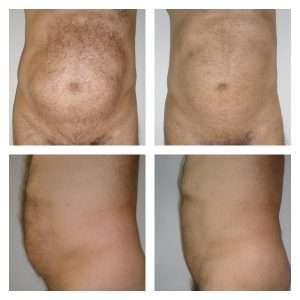 Liposuzione-Liposcultura 5
