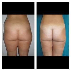 Liposuzione-Liposcultura 3