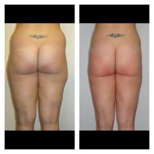 Liposuzione-Liposcultura 2