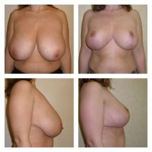 Esempio di Riduzione Seno - Mastoplastica Riduttiva Foto 2