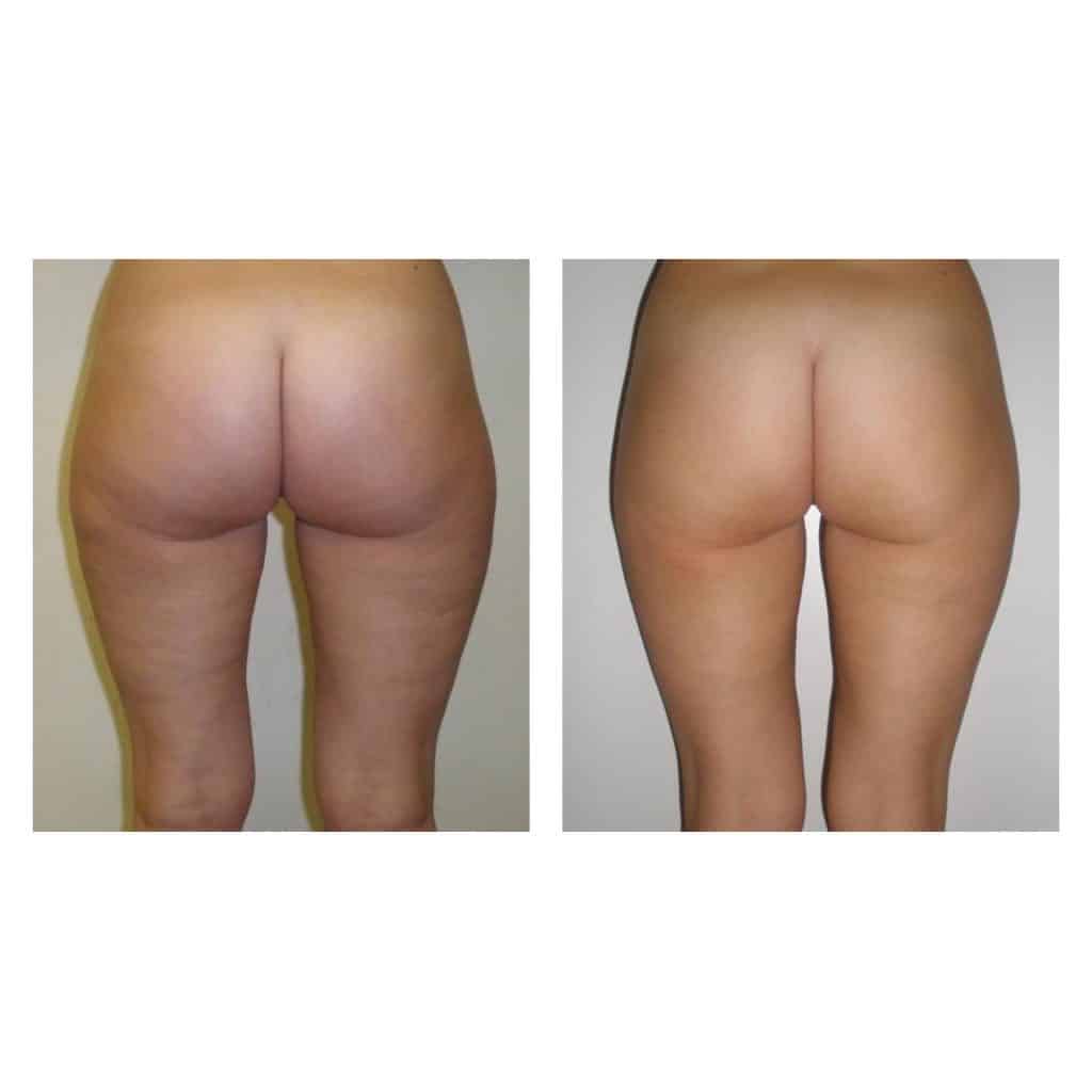 Mesoterapia Anti Cellulite