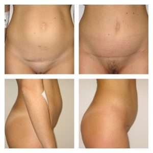 Mini addominoplastica