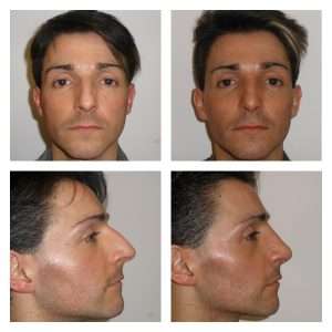 Rinoplastica 3