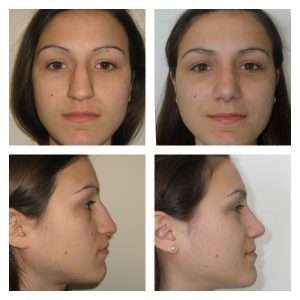 Rinoplastica 4