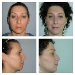 Rinoplastica 5
