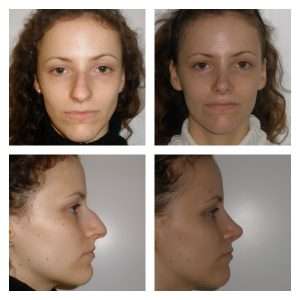 Rinoplastica 6