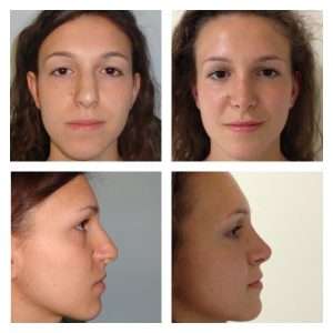 Rinoplastica 8