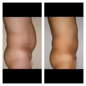 Liposuzione-Liposcultura