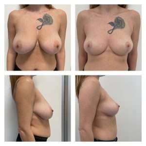 Mastoplastica Riduttiva 5