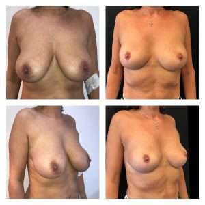 Mastoplastica Riduttiva 4