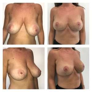 Mastoplastica Riduttiva 4