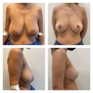 Mastoplastica Riduttiva 3