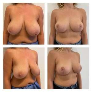 Mastoplastica Riduttiva 2