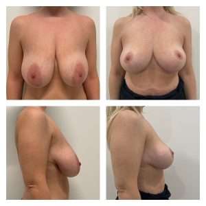 Mastoplastica Riduttiva
