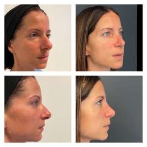 Rinoplastica 12