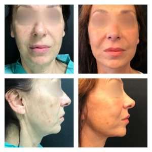 Lifting Facciale - Viso 4