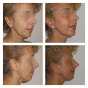 Lifting Facciale - Viso 3