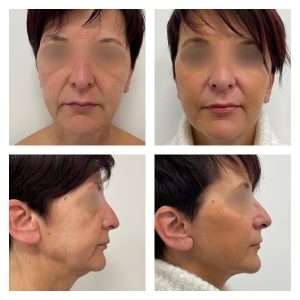 Lifting Facciale - Viso 2