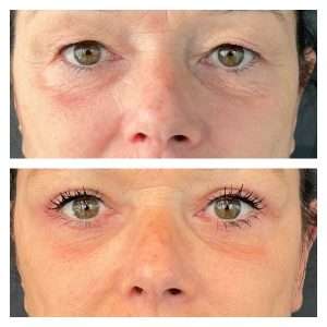 Blefaroplastica 9