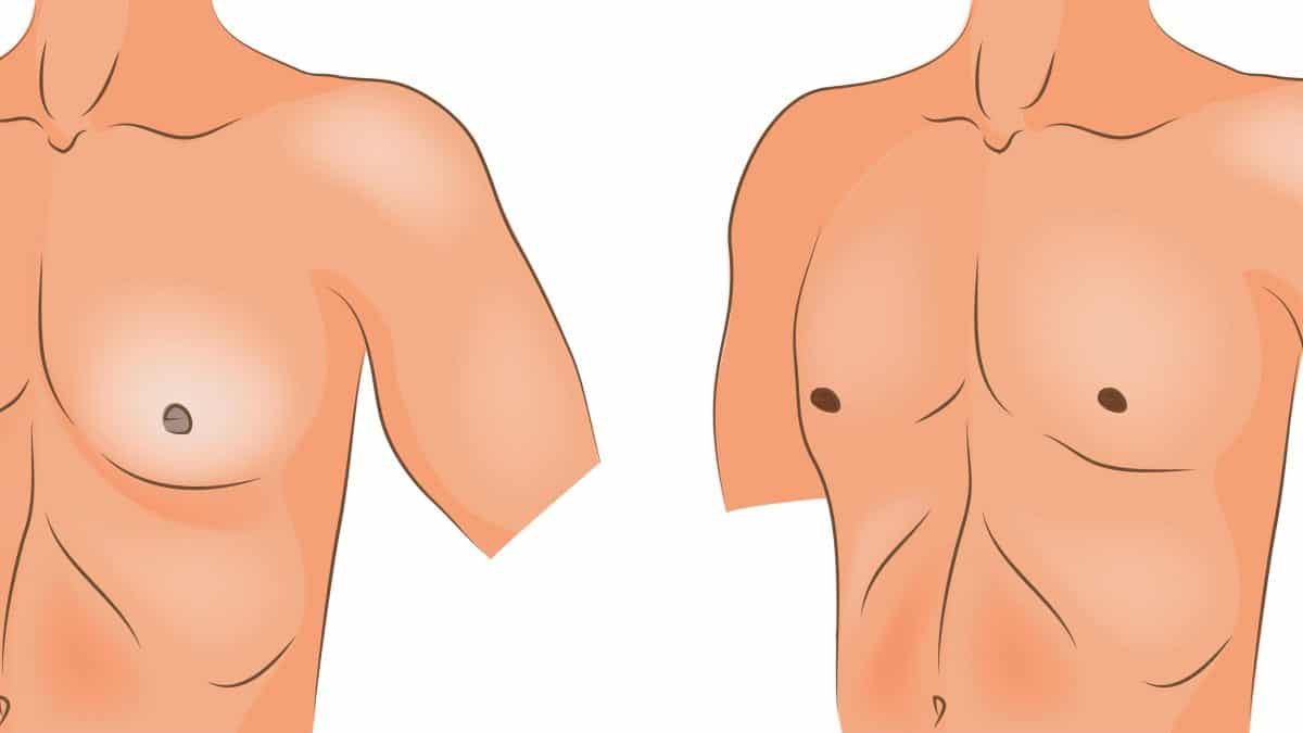 Decorsi: ginecomastia